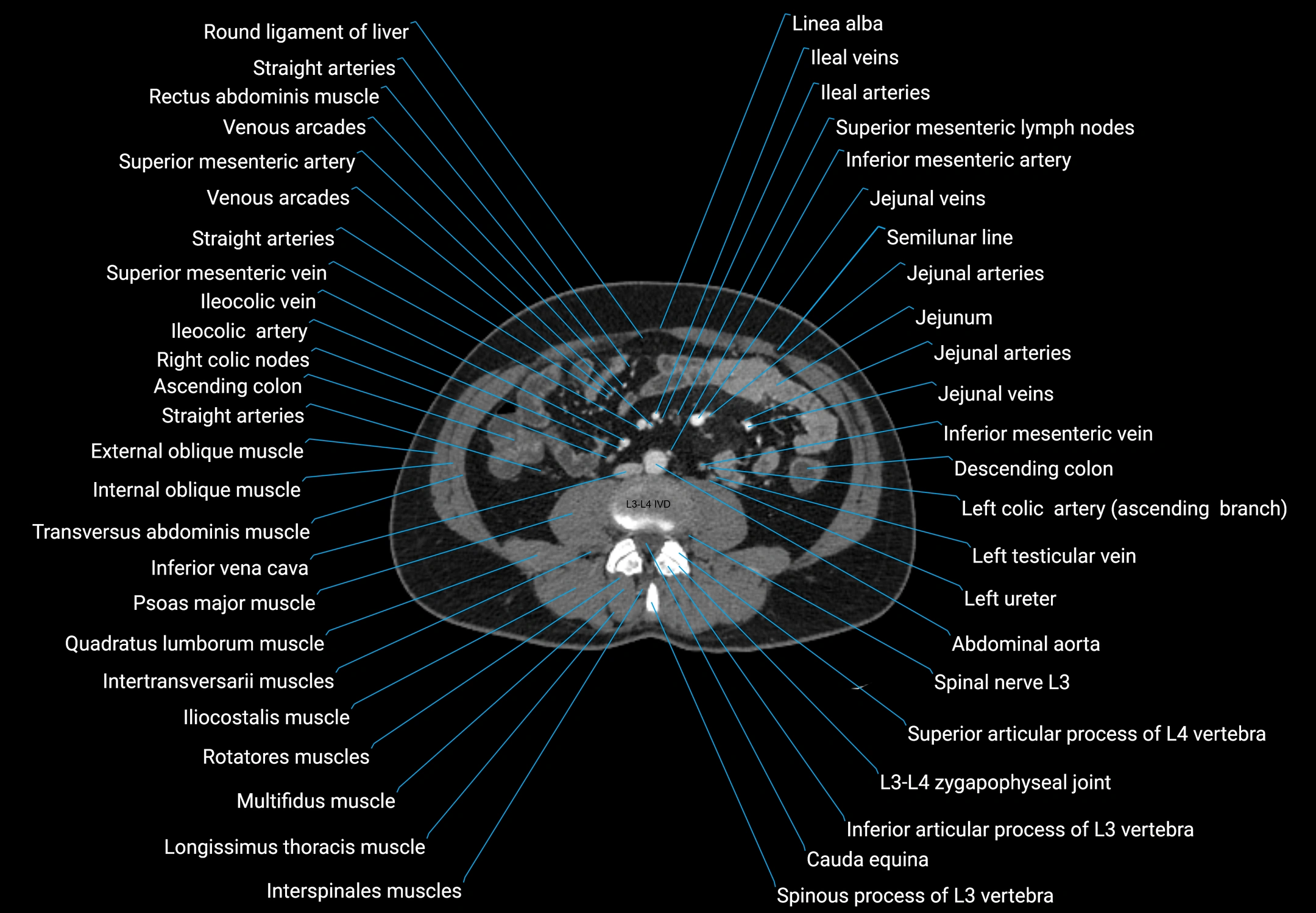 CT male pelvis axial cross sectional anatomy labelled radiology image -00101.webp